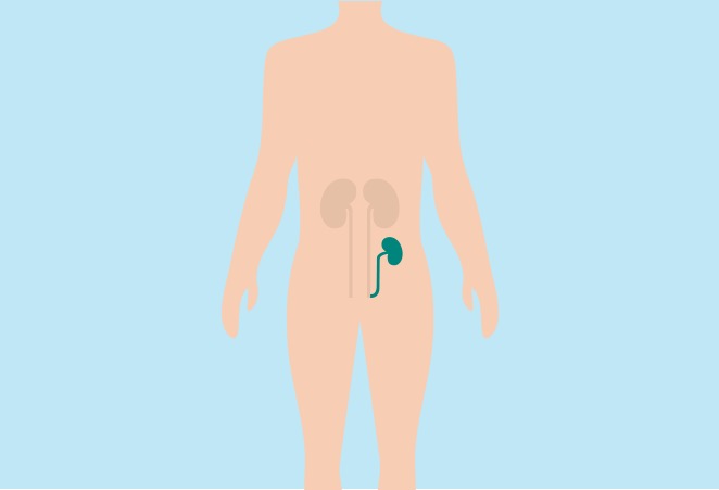 Image of a body with an animation of kidneys showing, with the transplanted kidney